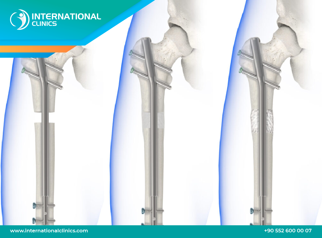 PRECICE Nail: The Internal Limb Lengthening Guide & Costs