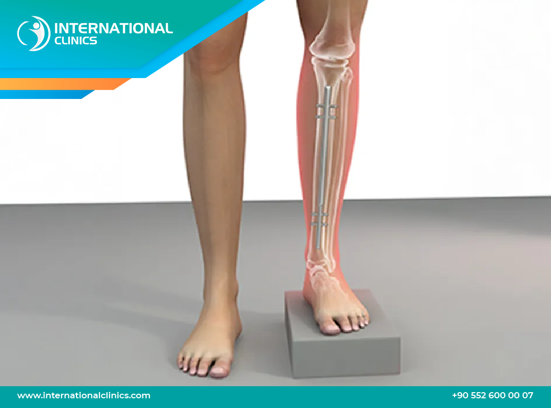 Tibial Limb Lengthening: Get Taller by Shin Bone Elongation