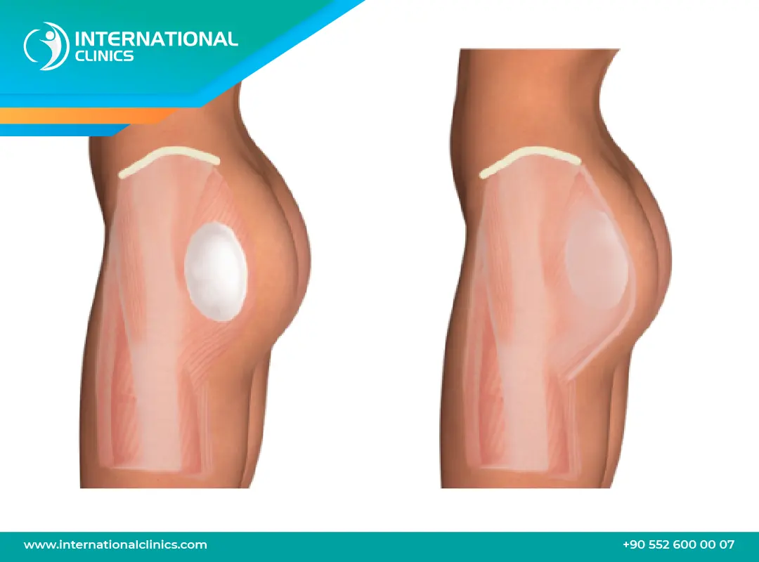 عملية سيليكون المؤخرة: الحل الأمثل لتكبير المؤخرة وتكلفتها بالتفصيل