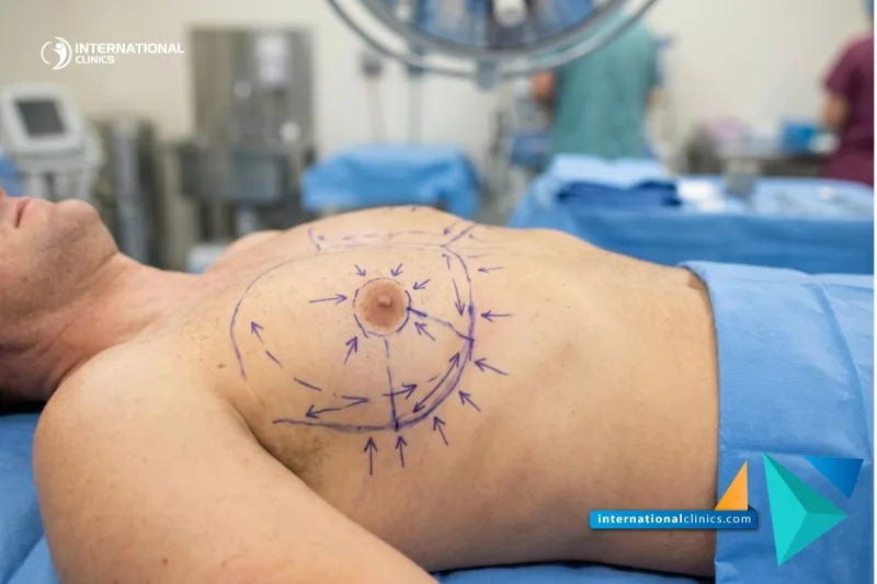 Close-up of a male patient's chest marked with surgical planning lines for Gynecomastia Surgery at International Clinics.