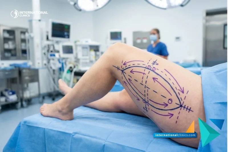 Sarcoma Treatment - Expert Care