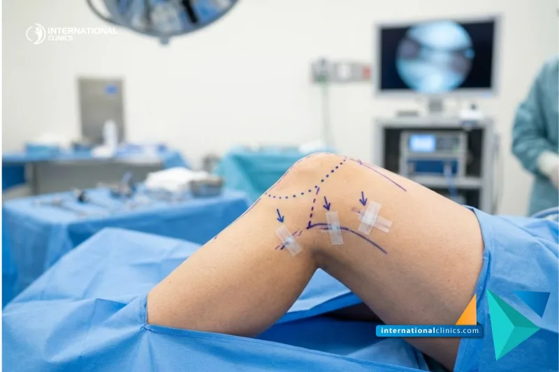 A clinical photograph of a patient's knee with surgical planning lines showing a successful Surgical Sports Medicine outcome at International Clinics.
