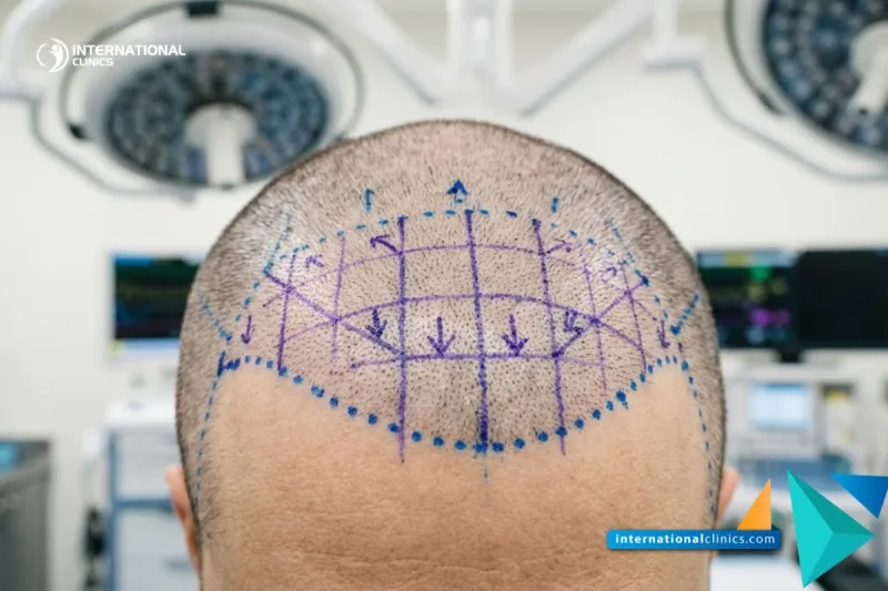 A close-up photograph of a patient's scalp marked with surgical planning lines for a Hair Transplant in Turkey and Egypt inside a sterile operating room at International Clinics.