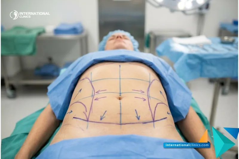 A clinical photograph of a patient's abdomen marked with blue surgical planning lines for Types of Liposuction at International Clinics.