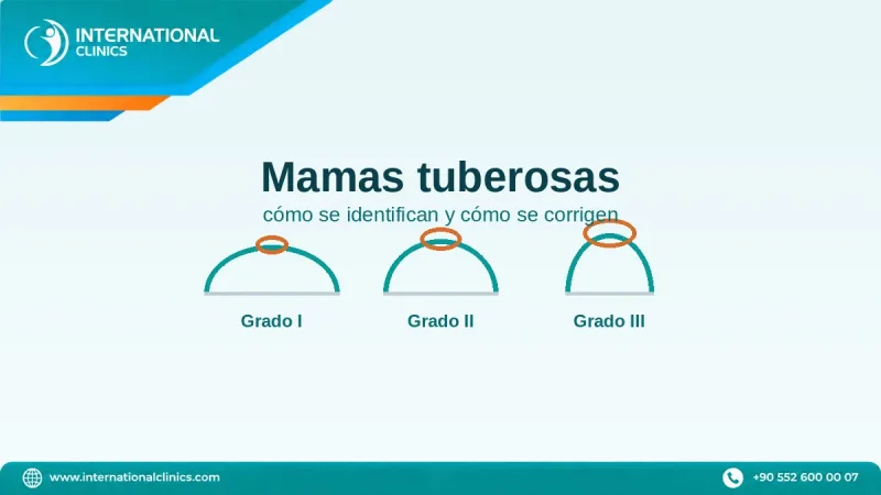 Mamas tuberosas: cómo saber si las tienes y cómo se corrigen