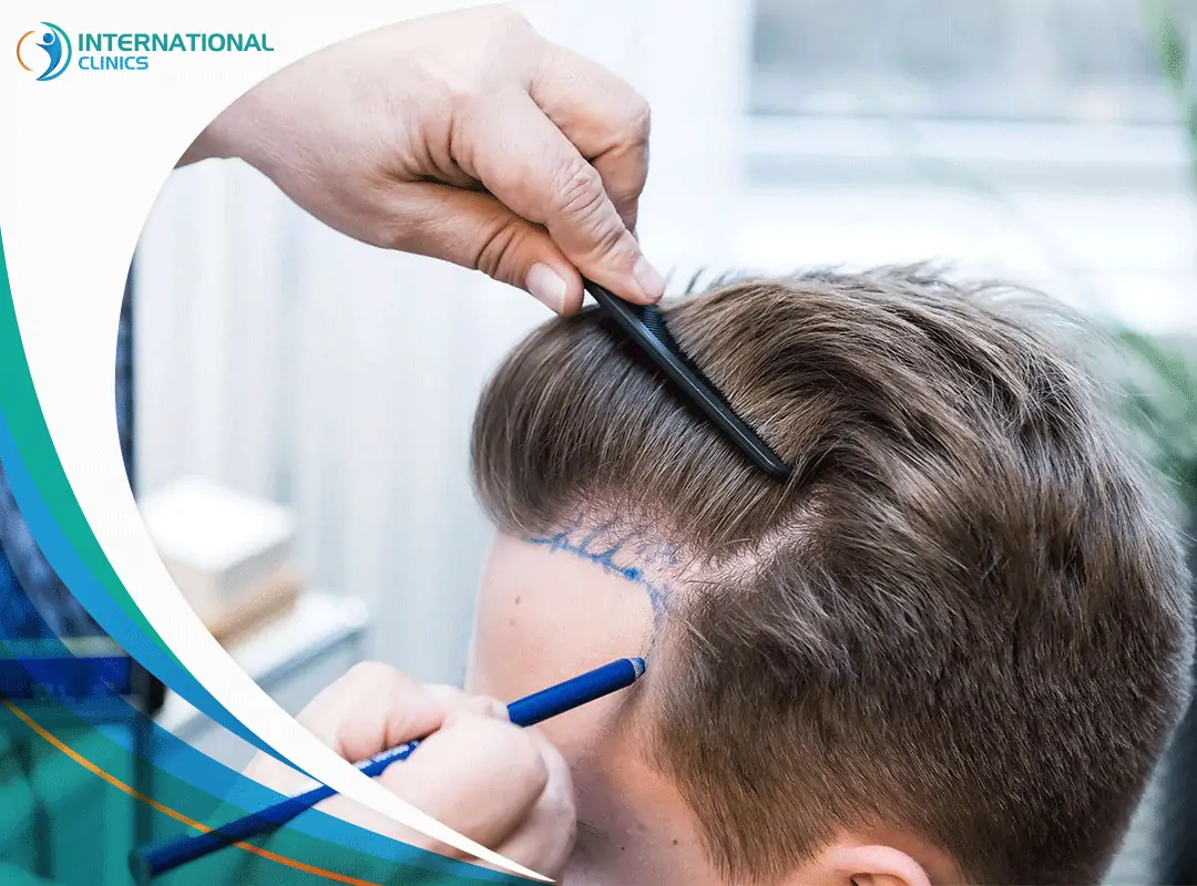 The Price of a New Look: Hair Transplant Cost in Turkey