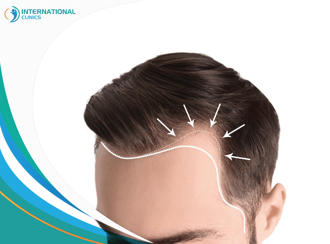 Greffe de cheveux pour homme en Turquie : techniques utilisées 