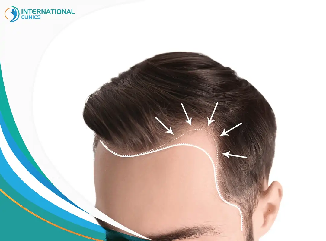 Greffe de cheveux pour homme en Turquie : techniques utilisées 2024