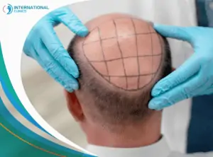 artificial hair transplant زراعة الشنب والذقن
