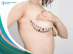breast augmentation تصغير الصدر من خلال شفط الدهون