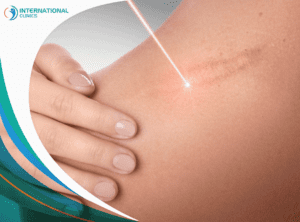 burn skin عمليات التجميل بعد الولادة في تركيا