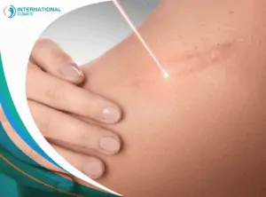 burn skin عمليات تجميل البطن