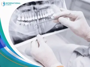 jaw surgery زراعة الأسنان في تركيا