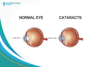 cataract disease تصوير الشبكية