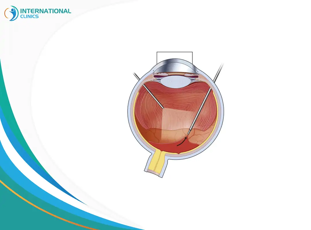 عملية إزالة الزجاجية من العين | النتائج وأبرز المعلومات عنها