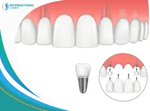 dental implants علاج الأسنان في تركيا