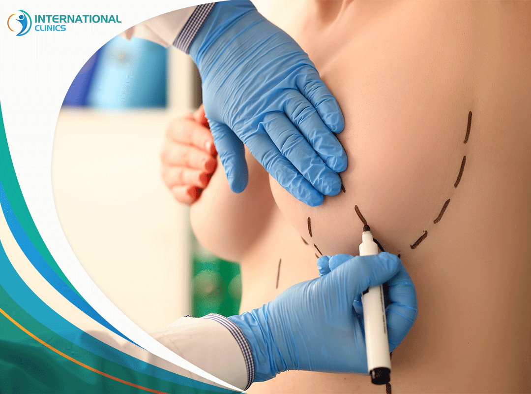 عملية تصغير الثدي (الصدر): إليكم أبرز الطرق الجراحية والطبيعية