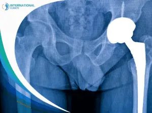Hip replacement مفصل الكاحل