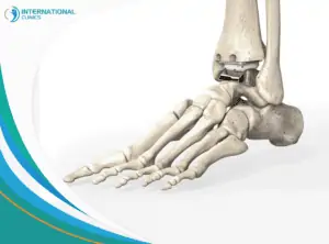 Ankle joint عملية مفصل الكتف