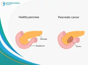 Pancreas cancer سرطان الثدي