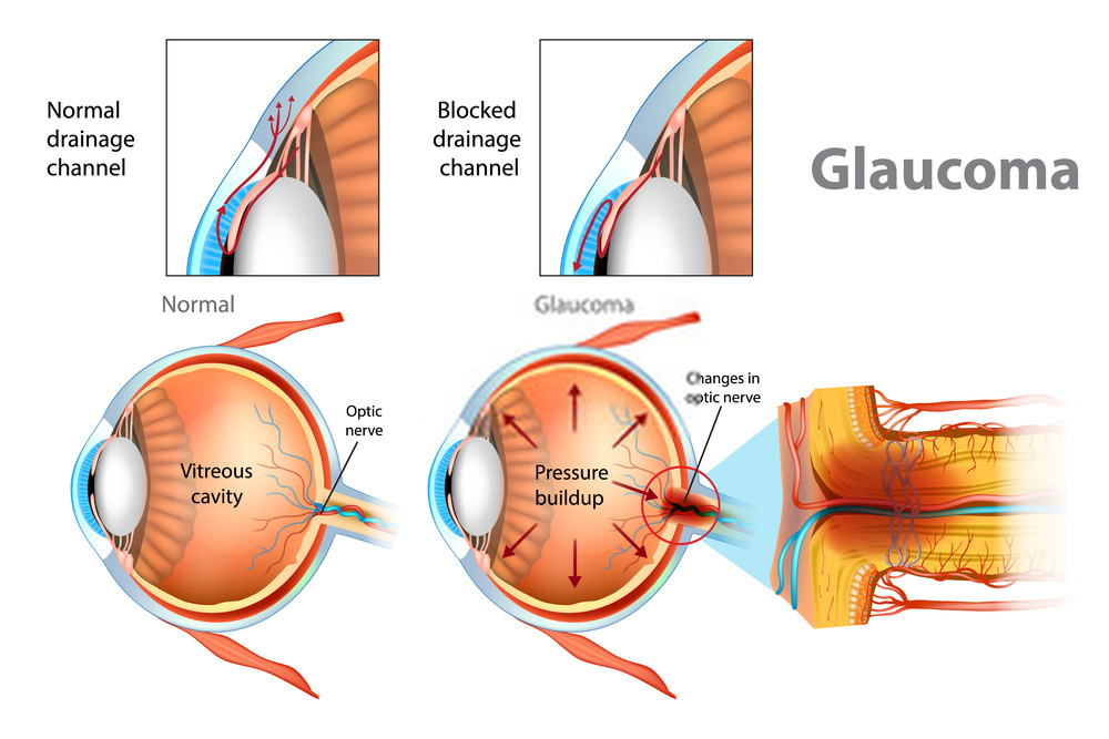 eye pressure - Glaucoma الجلوكوما