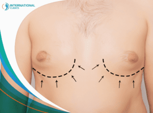 man Breast liposuction عملية شفط دهون البطن في تركيا