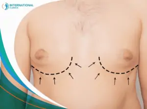 man Breast liposuction شفط الدهون بالليزر