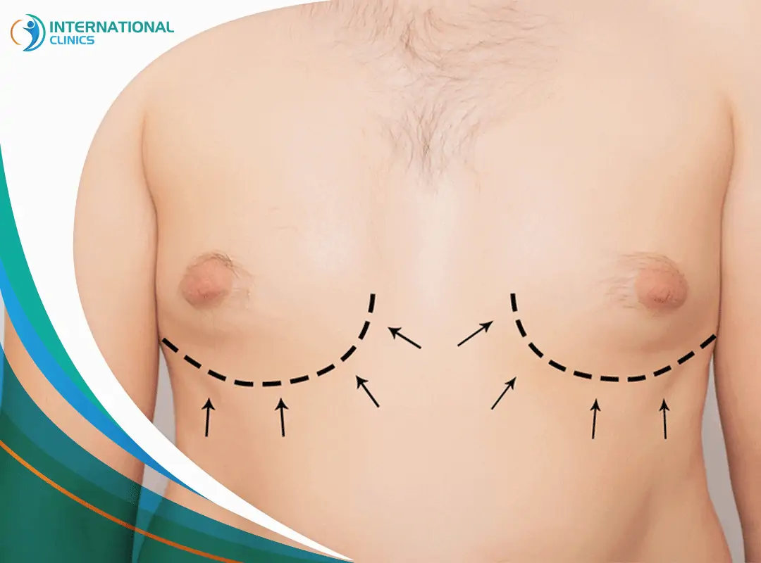 man Breast liposuction شفط دهون الثدي للرجال