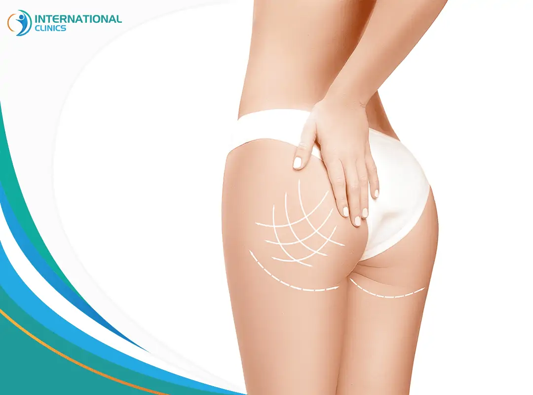 Buttock liposuction لیپوساکشن باسن در ترکیه