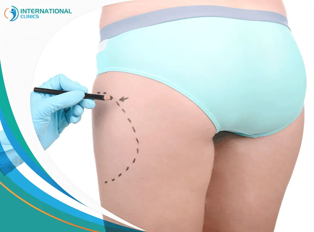 Liposuction 7 شفط دهون الفخذين