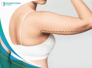arm Liposuction شفط الدهون بالفيزر في تركيا