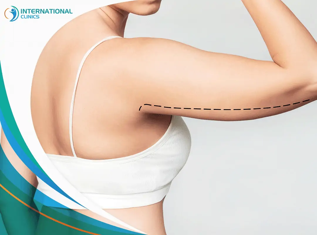 arm Liposuction شفط دهون الذراعين