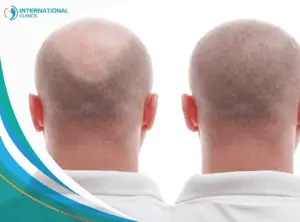 hair transplant surgery زراعة الشعر في تركيا