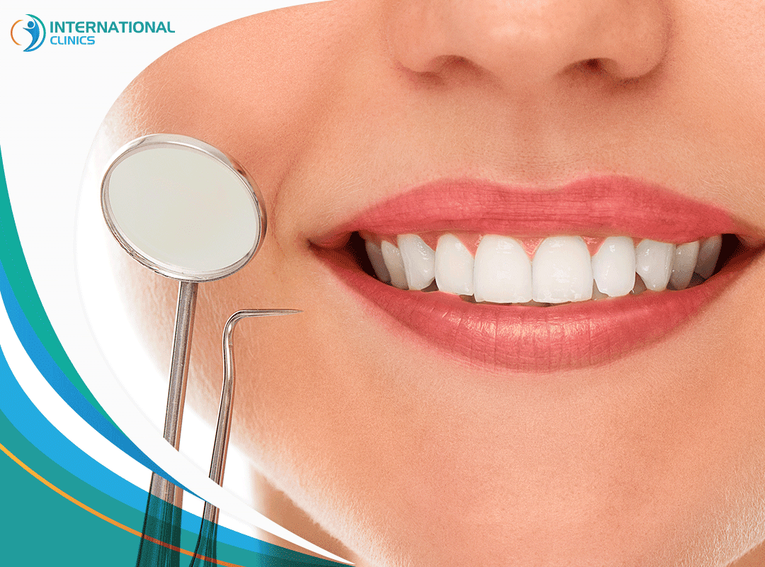 فينير الأسنان (Dental Veneer) | الأنواع والخطوات والمميزات