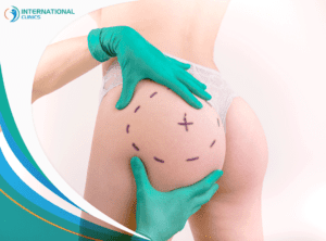 Brazilian butt Best Gastric Sleeve Surgery in Turkey