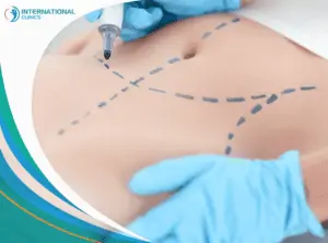 liposuction33 مدة الشفاء من عملية شد البطن