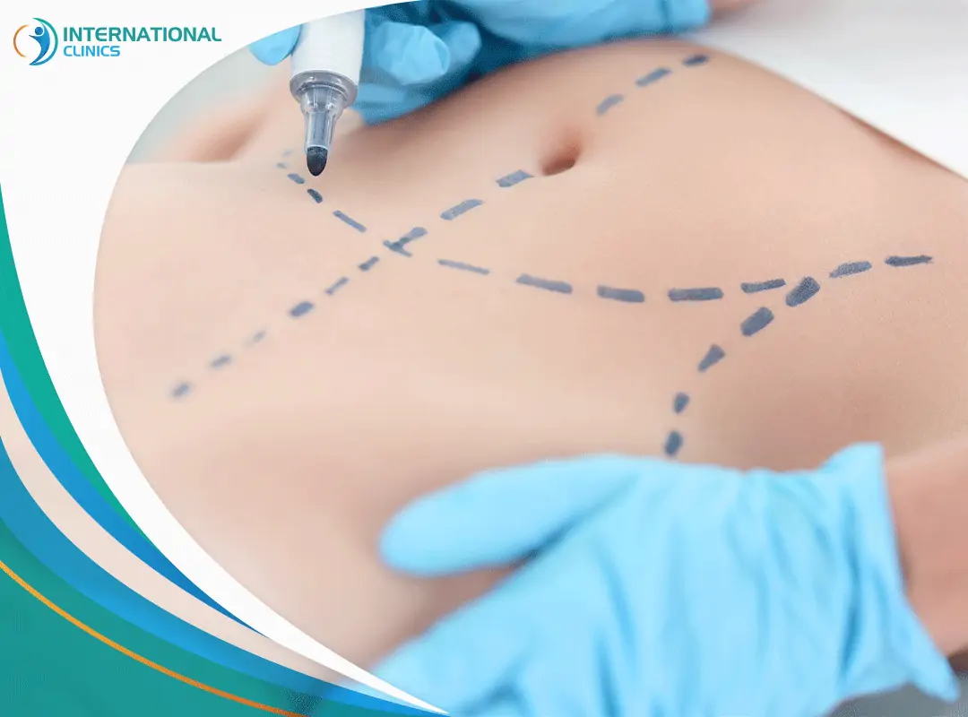 liposuction33 عملية شفط الدهون بالفيزر