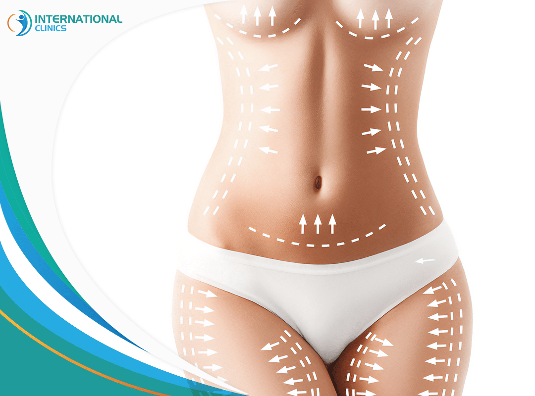 Liposuction Surgery Explained: Your Complete Step-by-Step Guide