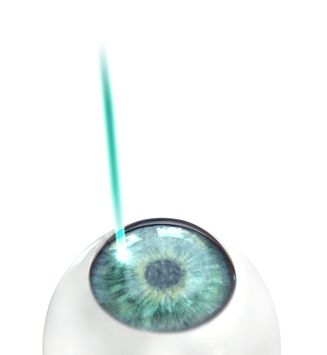 Femtosecond-Assisted LASIK