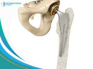 hip replacement عملية تطويل القامة