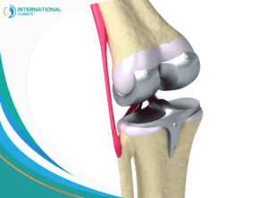 knee joint replacement جراحة اليد