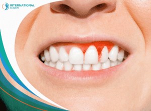 periodontal disease2 التخلص من الأسنان الصفراء