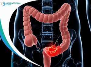 Abdominal perineal resection استئصال القولون