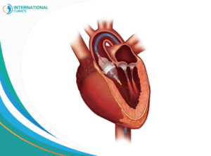 Aortic valve replacement استبدال صمامات القلب