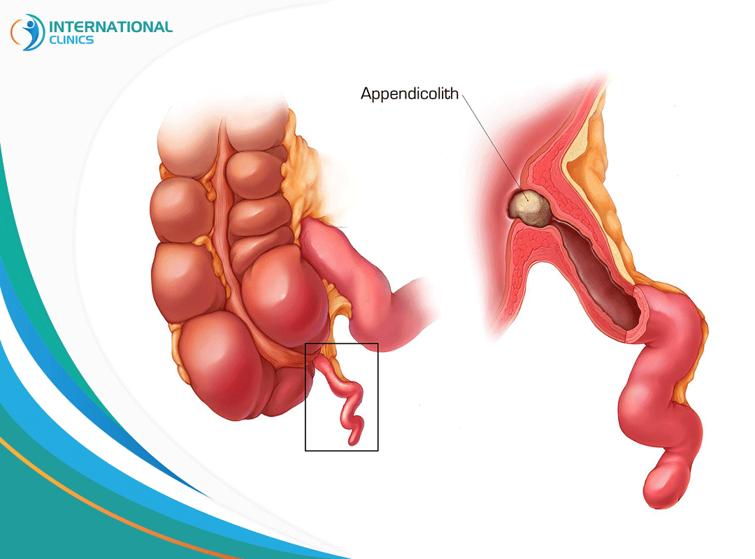Appendicitis التهابات الزائدة