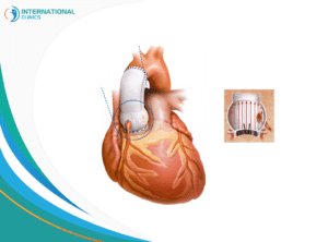 Bental operation استبدال صمامات القلب
