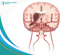 Brain hematoma surgery جراحة المخ والأعصاب عند الأطفال