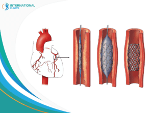 Coronary artery استبدال الصمام الأبهري