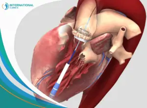 Sustitución de Válvulas Cardíacas