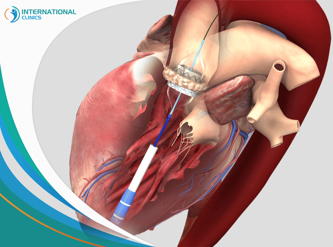Heart valve replacement استبدال صمامات القلب
